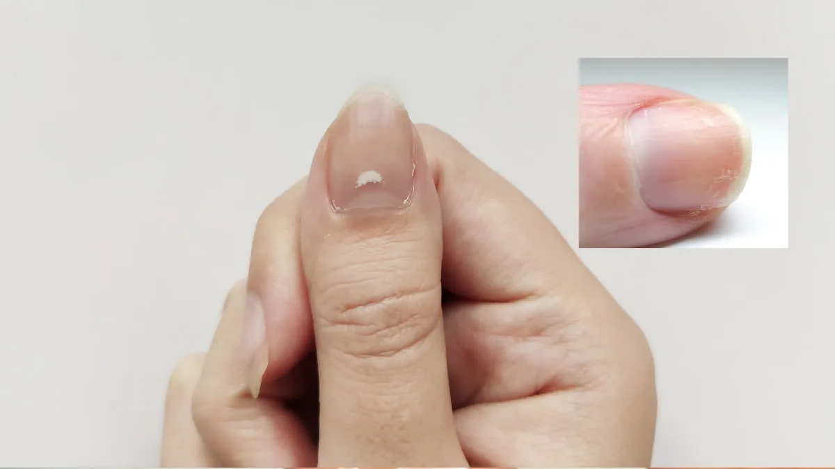 Lung cancer symptoms can be seen on your fingers! Check for signs and symptoms and be careful!