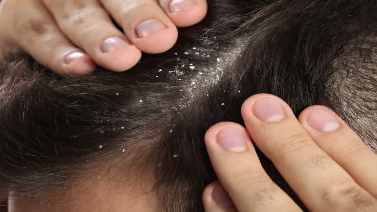 If you are troubled by dandruff in winter, then definitely adopt these 5 remedies
