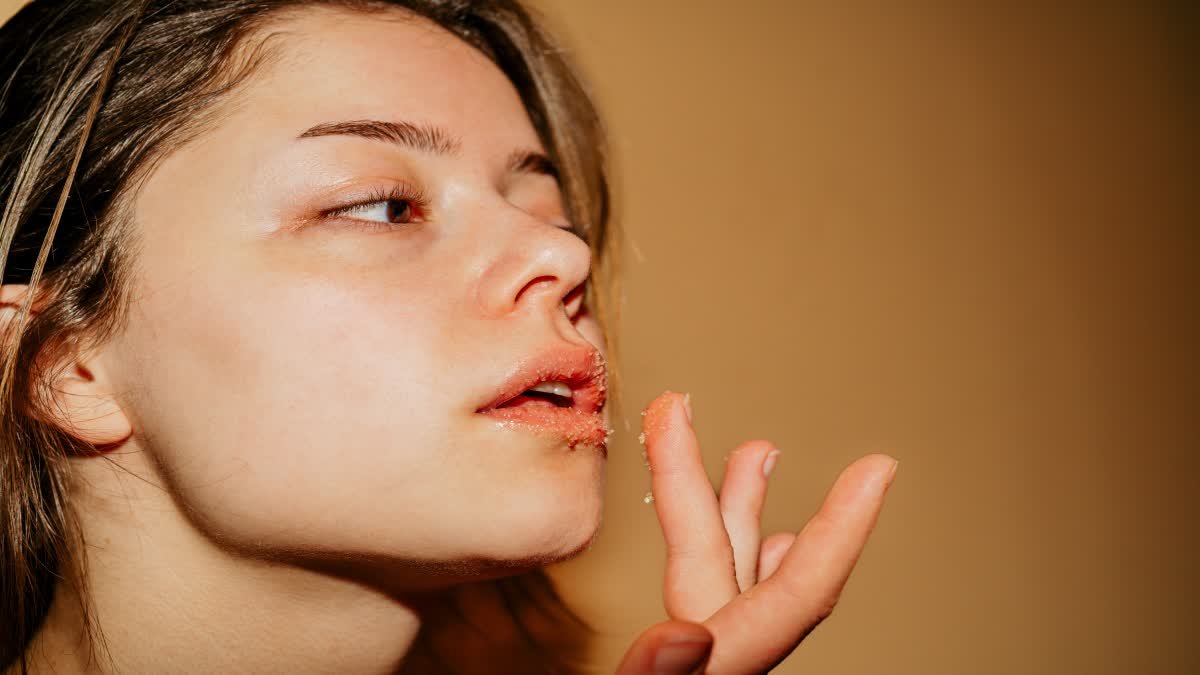 Are you also troubled by dry and chapped lips?