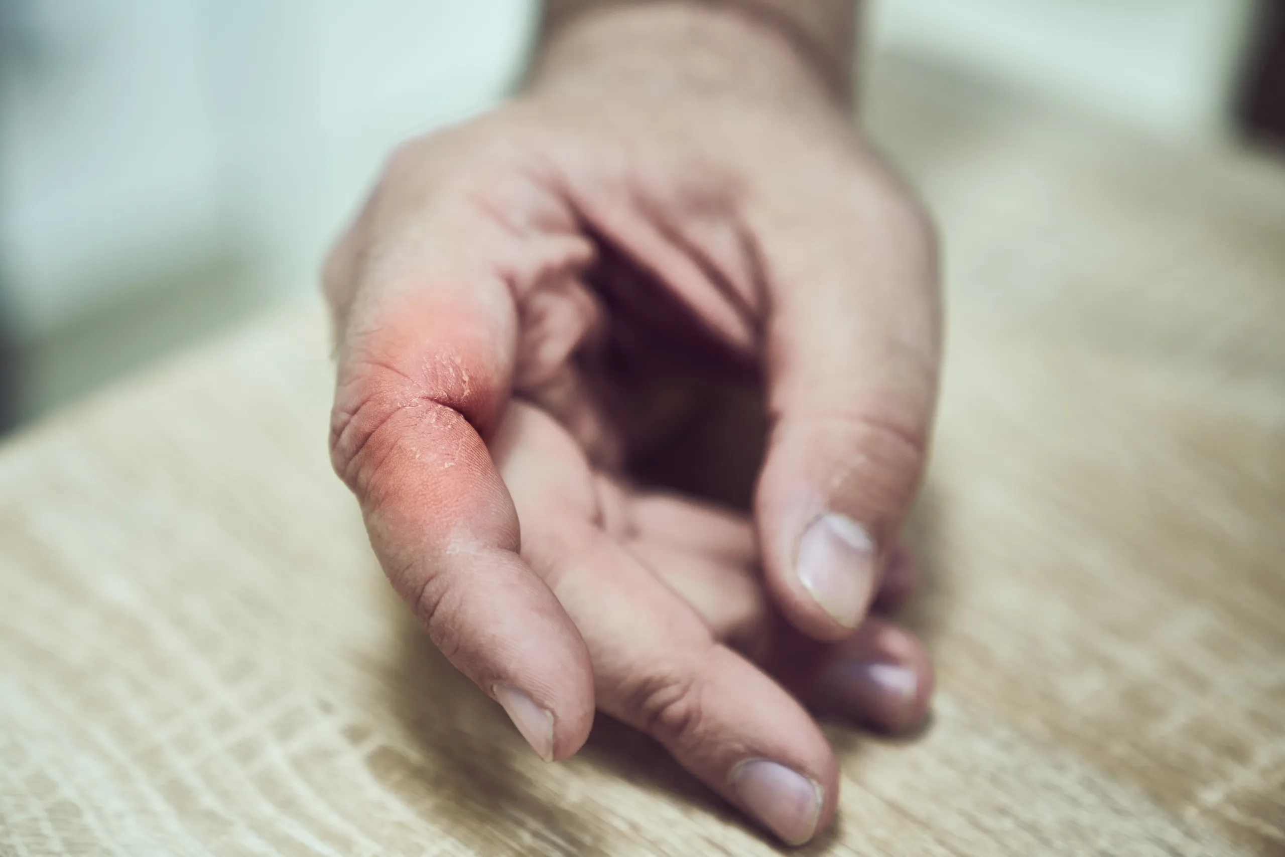 WARNING SYMPTOMS OF URIC ACID