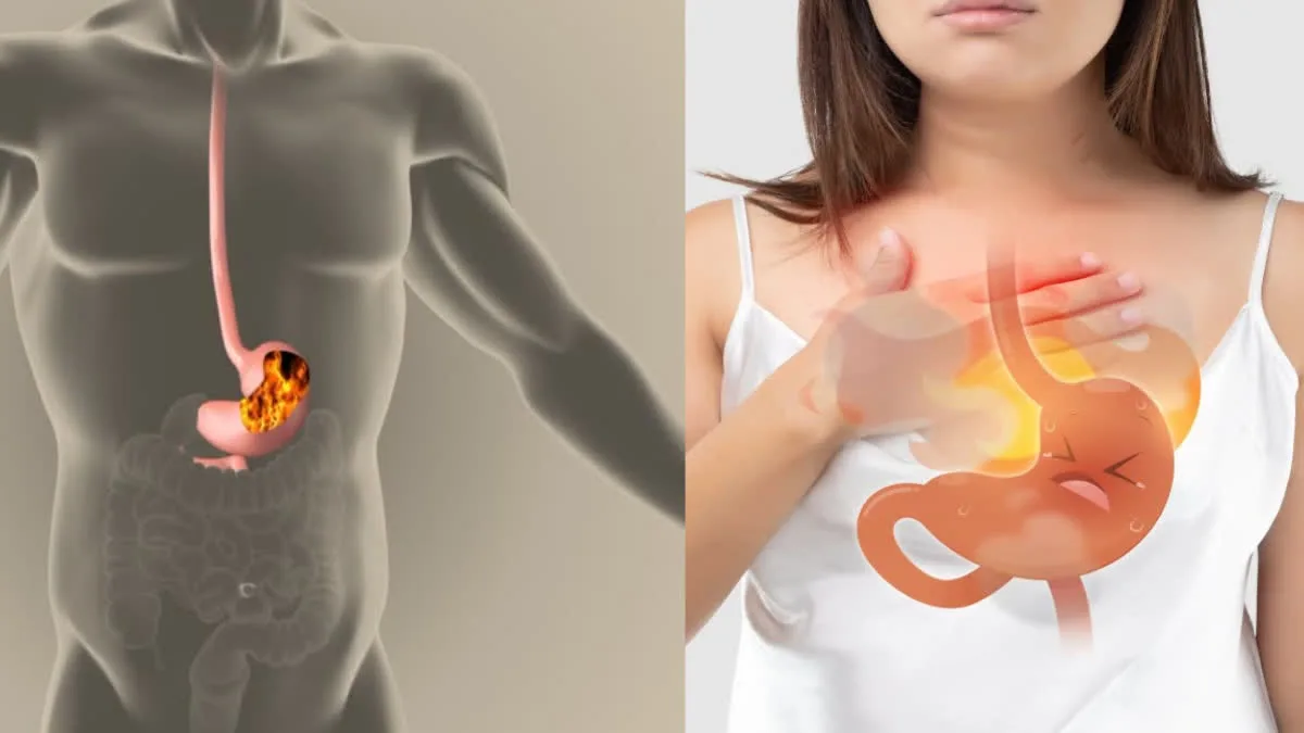 Piles vs IBD Could you be overlooking IBD, mistaking it for hemorrhoids?