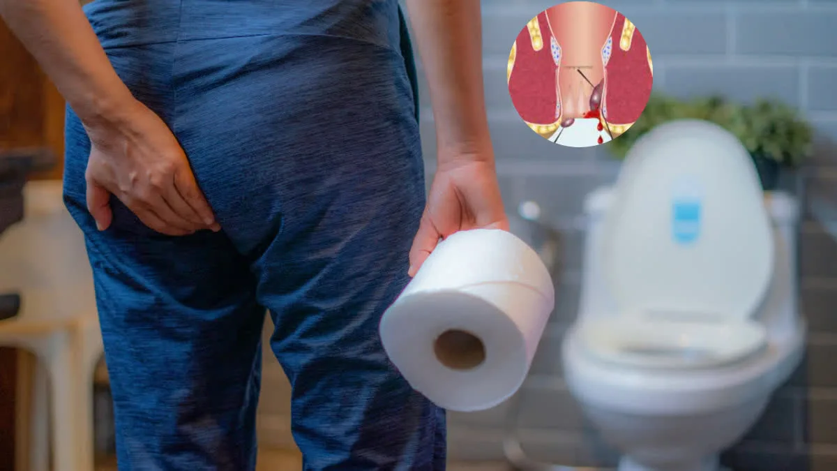 Piles vs IBD Could you be overlooking IBD, mistaking it for hemorrhoids?