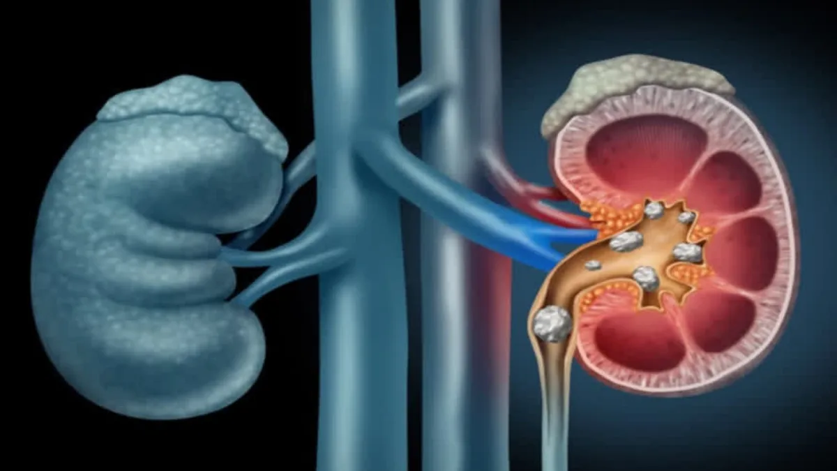 These Symptoms May Appear in the Early Stages of Kidney Cancer Doctor Explains in Detail
