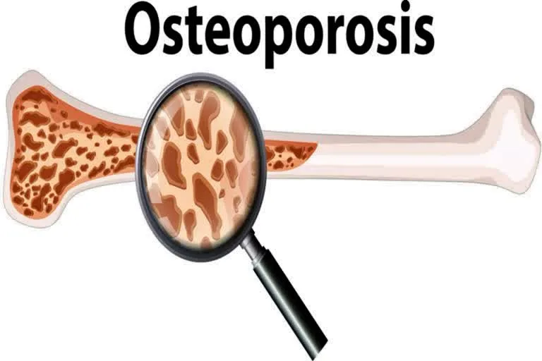 Why are women more prone to osteoporosis than men? Know the cause and methods of prevention