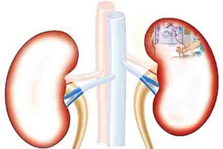 Kidney Disease to Become the Fifth Leading Cause of Death by 2040, Reveals 'The Lancet' Research