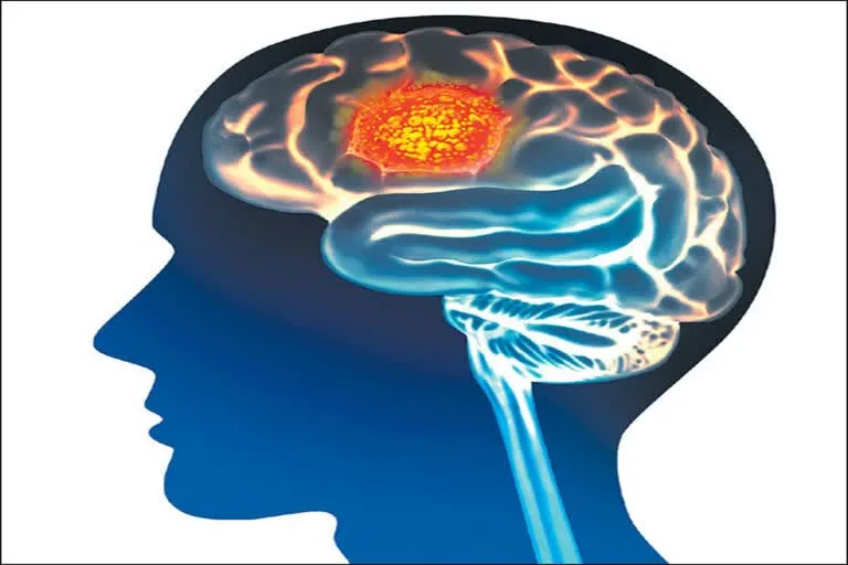 How does a tumor form in the brain? What is Central Nervous System (CNS) Lymphoma? Which symptoms should not be ignored?