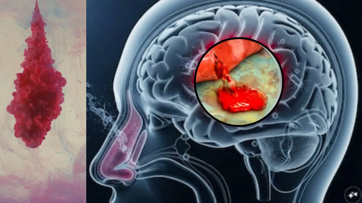 How does a tumor form in the brain? What is Central Nervous System (CNS) Lymphoma? Which symptoms should not be ignored?