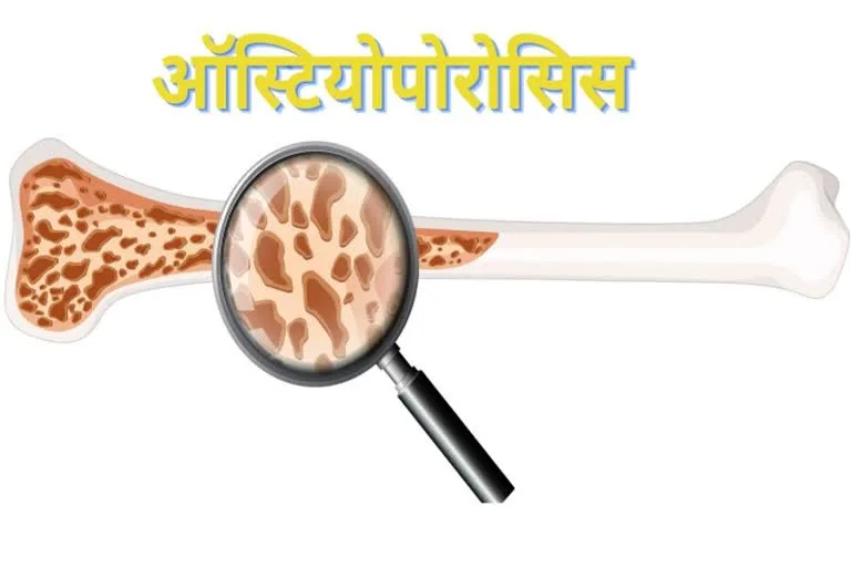 Why is the problem of osteoporosis and low bone density increasing among younger men?